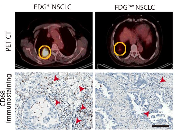 Tumor-Associated Macrophages Enhance Tumor Hypoxia and Aerobic Glycolysis
